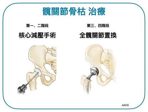 為什麼會骨枯|【01醫務所】髖關節骨枯病人難自覺患病 高危人士需。